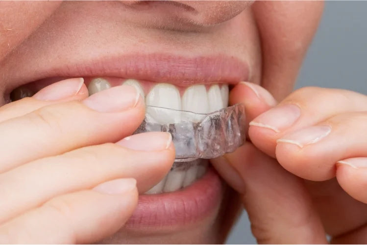 Een meisje dat duidelijke aligners aanbrengt om de tanden recht te trekken