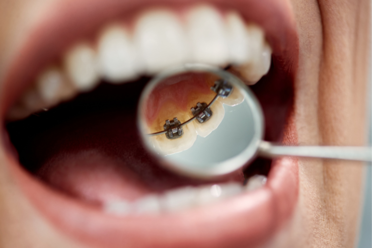 Een lachende vrouw met een klasse I-beet.