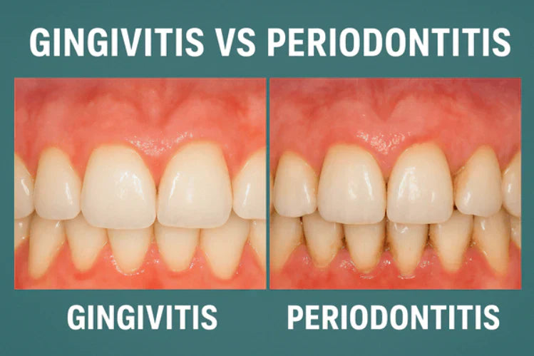 Vergelijking van gingivitis en parodontitis naast elkaar.