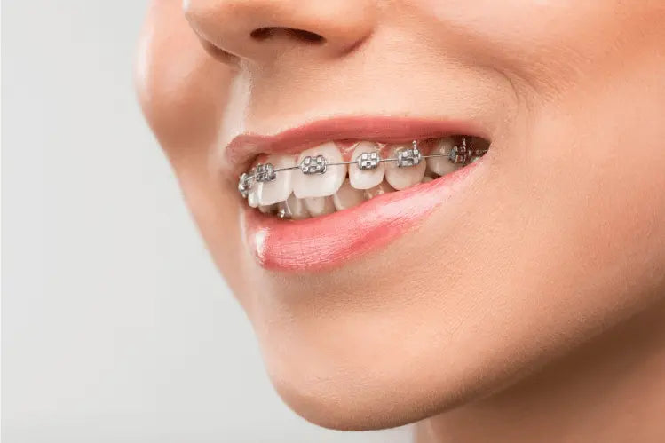 overbite wearing braces